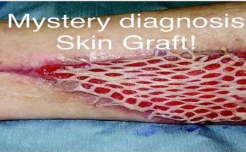 How Long Does it Take to Recover From a Skin Graft